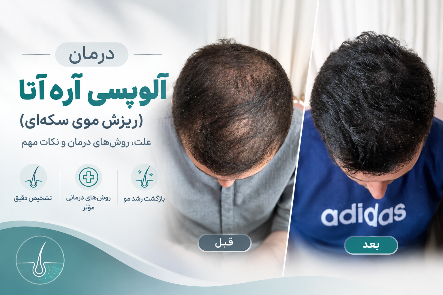 درمان آلوپسی آره آتا