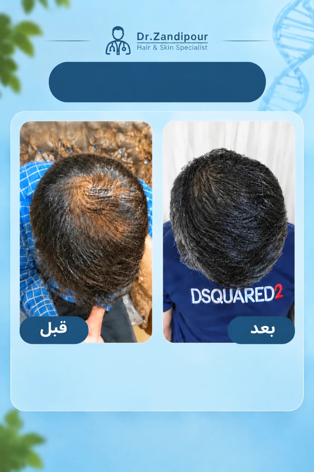 داروی ماینوکسیدیل برای درمان ریزش مو
