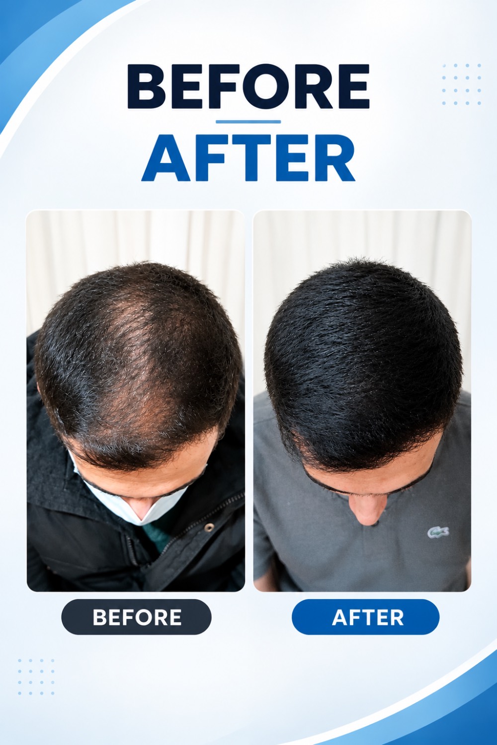 تاپیک یا پودرهای پرپشت‌کننده یا اسکالپ؛ کدام بهتر است؟